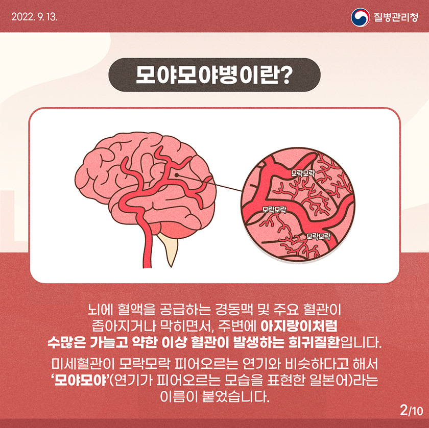 [2022년 9월 13일 질병관리청] 모야모야병이란? 뇌에 혈관을 공급하는 경동맥 및 주요 혈관이 좁아지거나 막히면서, 주변에 아지랑이처럼 수많은 가늘고 약한 이상 혈관이 발생하는 희귀질환입니다. 미세혈관이 모락모락 피어오르는 연기와 비슷하다고 해서 '모야모야'(연기가 피어오르는 모습을 표현한 일본어)라는 이름이 붙었습니다. [10페이지 중 2페이지]